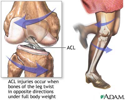 Acl Damage