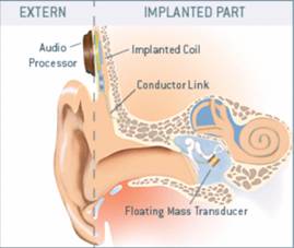 inner ear prosthesis