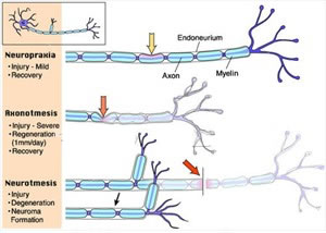 Nerve Injury Extent