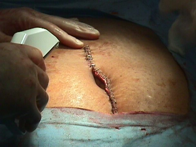 Staples in surgery
