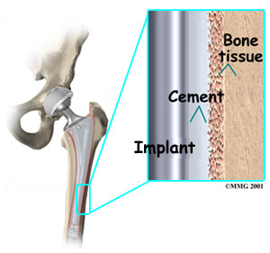 http://www.jointreplacement.com/bin/images/hip/during%20surgery/uncemented.jpg