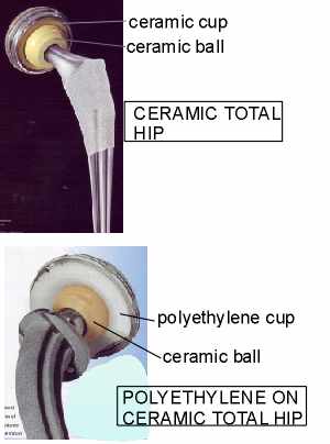 http://www.totaljoints.info/CeramicTH_PE.jpg