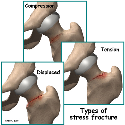 http://www.eorthopod.com/images/ContentImages/hip/hip_stress_fracture/hip_stressfx_anatomy02.jpg