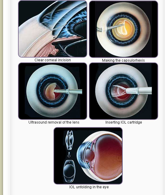 Удаление катаракты clinicaspectr ru. Катаракта факоэмульсификация. Лазерная дисцизия вторичной катаракты. Факоэмульсификация катаракты с имплантацией ИОЛ. Ультразвуковое хирургия катаракты - факоэмульсификация.