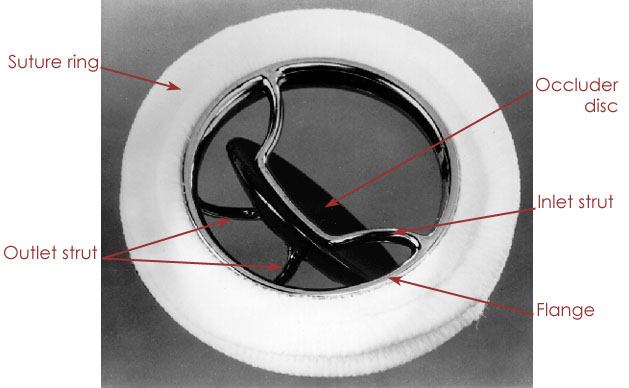 How Long Do Mechanical Mitral Valves Last