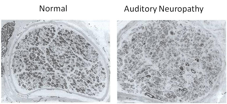 hearing-loss-and-auditory-cells