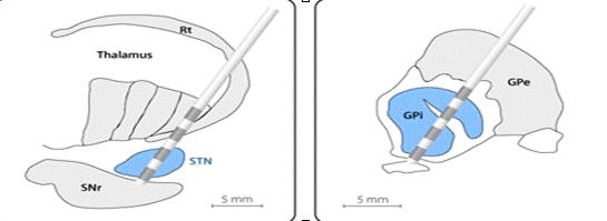 Subthalamic Nucleus and the Globus Pallidus